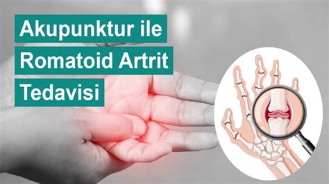 romatoid artrit akut dönem ortez